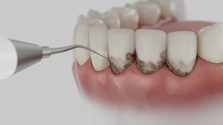 Trusted Wisdom Tooth Removal service in Battle Creek, MI - Dentist Open Now